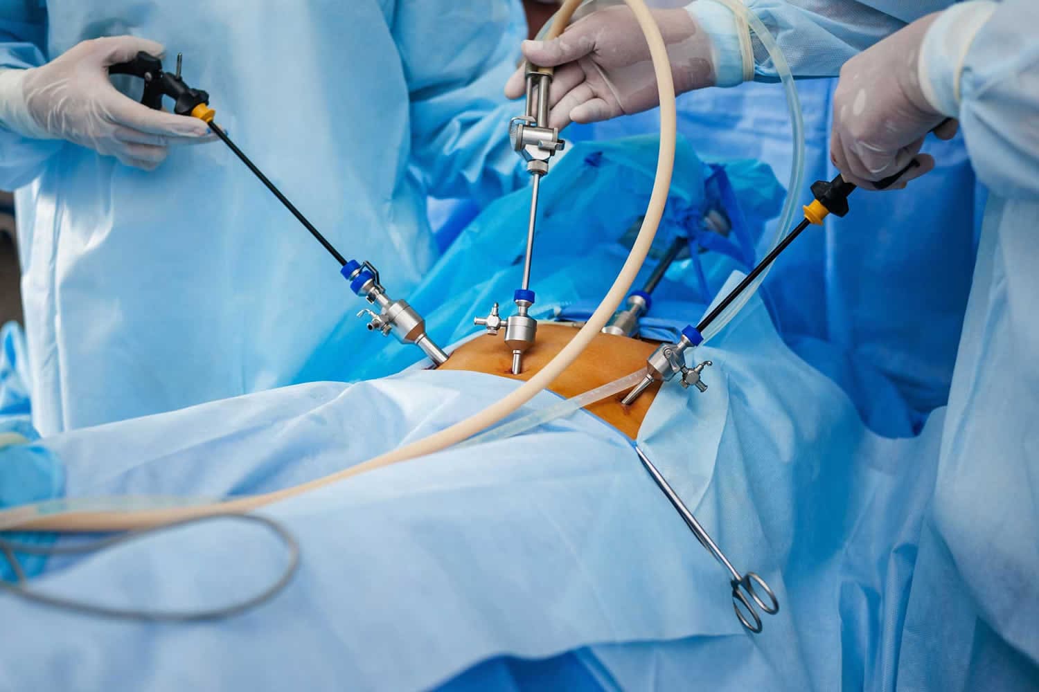 Laparoscopic Surgery in Lucknow