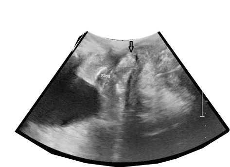 Endoanal ultrasonography